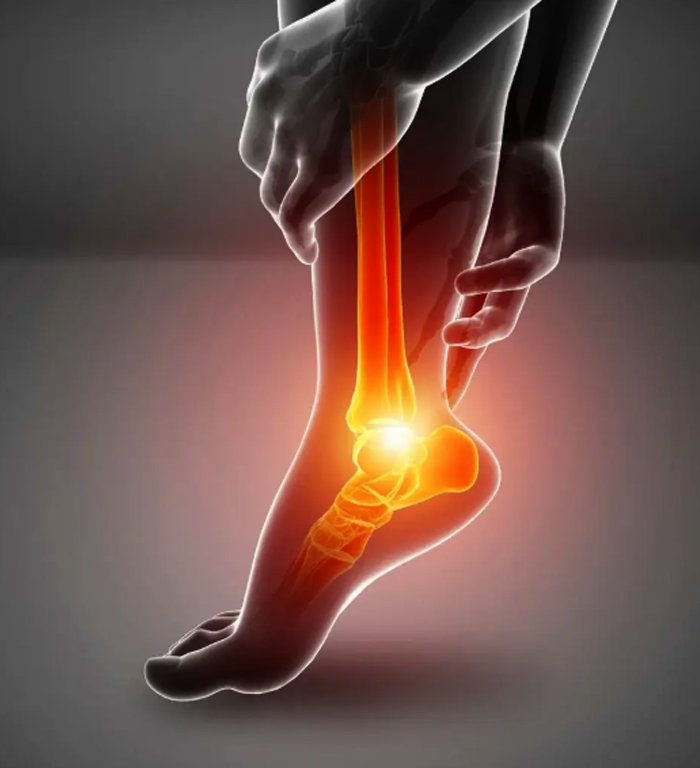 Plantar Fasciitis: Symptoms  and Causes