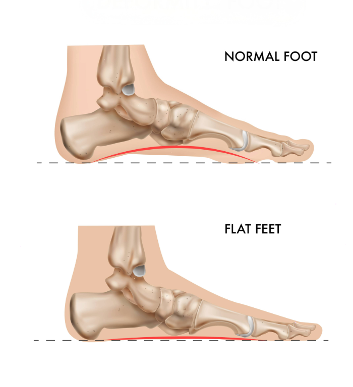 Flat Foot Support Shoes | Best Arch Support & Orthopedic Footwear Guide